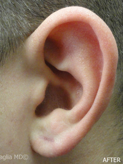 EarLobe repair nyc_after